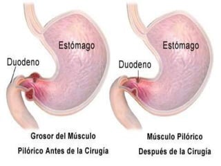 duplicaciones o megacolon agangliónico.