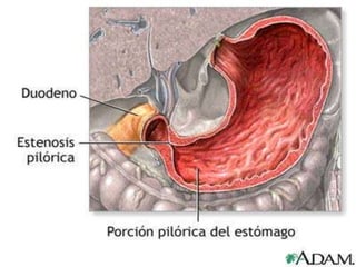 Hipergastrinemia.