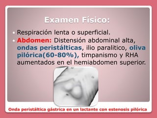 Estenosis Hipertrofica del Piloro | PPTX