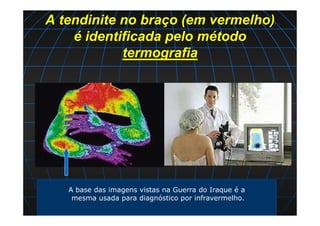 A tendinite no braço (em vermelho)
é identificada pelo método
termografia
A base das imagens vistas na Guerra do Iraque é a
mesma usada para diagnóstico por infravermelho.
 