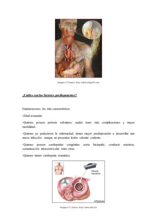 Imagen n°2.Fuente: http://odontologia20.com
¿Cuáles son los factores predisponentes?
Enumeraremos los más característicos
-Edad avanzada.
-Quienes poseen prótesis valvulares: suelen tener más complicaciones y mayor
mortalidad.
-Quienes ya padecieron la enfermedad: tienen mayor predisposición a desarrollar una
nueva infección aunque no presenten lesión valvular evidente.
-Quienes poseen cardiopatías congénitas: aorta bicúspide, conducto arterioso,
comunicación intraventricular entre otras.
-Quienes tienen cardiopatía reumática.
Imagen n°3. Fuente: http://www.mhs.net
 