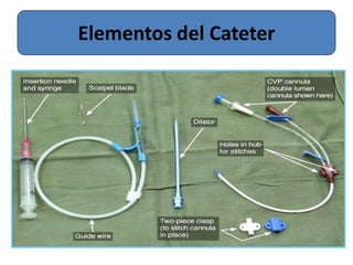 Elementos del Cateter
 