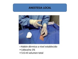 ANESTESIA LOCAL
• Habón dérmico a nivel establecido
• Lidocaína 1%
• 5-6 ml volumen total
 