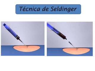 Técnica de Seldinger
 