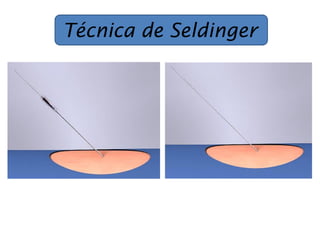 Técnica de Seldinger
 