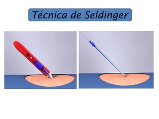 Técnica de Seldinger
 
