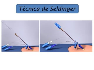 Técnica de Seldinger
 