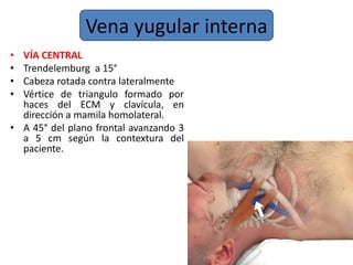 Vena yugular interna
• VÍA CENTRAL
• Trendelemburg a 15°
• Cabeza rotada contra lateralmente
• Vértice de triangulo formado por
haces del ECM y clavícula, en
dirección a mamila homolateral.
• A 45° del plano frontal avanzando 3
a 5 cm según la contextura del
paciente.
 