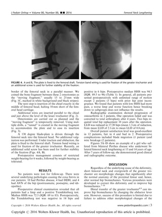 border of the femoral neck in a parallel manner. We
coined the bone fragment between these 2 osteotomies as
the “moving fragment,” usually 15 to 25 mm wide
(Fig. 1C, marked in white background and black stripes).
The next step is insertion of the chisel exactly in the
middle of femoral head, halting 10 mm short of the fem-
oral head cartilage.
Additional wires are inserted parallel to the chisel
and just above the level of the lesser trochanter (Fig. 2).
Osteotomies are carried out as planned and the
“moving fragment” is temporarily removed. Using mul-
tiple drills, a “tunnel” is created in the moving fragment
to accommodate the plate and to ease its insertion
(Fig. 3).
A 130 degree blade-plate is driven through the
femoral neck into the femoral head. No additional valg-
ization was performed. Under traction and abduction, the
plate is ﬁxed to the femoral shaft. Tension band wiring is
used for ﬁxation of the greater trochanter. Recently, an
additional solid screw has been used for further stability
of the ﬁxation (Figs. 4A, B).
Postoperative management consists of restricted
weight-bearing for 6 weeks, followed by weight-bearing as
tolerated.
RESULTS
No patients were lost for follow-up. There were
several underlying pathologies causing the coxa brevis in
our patients: 10 had Perthes disease, 4 had DDH, and 4
had AVN of the hip (posttraumatic, postseptic, and idi-
opathic).
Preoperative clinical examination revealed that all
patients had a limp and a positive Trendelenburg test.
Median HHS was 72.5 (IQR: 69 to 83). Postoperatively,
the Trendelenburg test was negative in 14 hips and
positive in 6 hips. Postoperative median HHS was 94.5
(IQR: 89.5 to 96) (Table 1). In general, all patients pre-
sented postoperatively with unlimited range of motion
except 2 patients (3 hips) with prior hip joint incon-
gruence. We found that patients with low HHS had more
pain, a worse limp and worse function hence breaking
down to subgroups does not inﬂuence the results.
Radiographic examination showed progression of
osteoarthritis in 3 patients. One operation failed and was
converted to total arthroplasty after 4 years. Two hips re-
quired total hip replacement 10 years after the operation.
LLD was reduced in 17/20 hips (mean 1.3 cm of reduction,
from mean LLD of 2.1 cm to mean LLD of 0.8cm).
Overall patient satisfaction level was good-excellent
in 12 patients, fair in 4 and bad in 2. Postoperative
complications included blade migration (1 patient (and
wire breakage (2 patients).
Figures 5A–D show an example of a girl who suf-
fered from bilateral Perthes disease who underwent bi-
lateral femoral neck lengthening at 13 and 14 years of age.
After 7 years of follow-up, she demonstrated good clinical
and radiographic outcome.
DISCUSSION
Regardless of the underlying cause of the deformity,
short femoral neck and overgrowth of the greater tro-
chanter are morphologic changes that signiﬁcantly alter
the normal anatomy of the proximal femur and, hence,
alter normal hip biomechanics. Various procedures were
developed to correct this deformity and to improve hip
biomechanics.7–10
Distal transfer of the greater trochanter8,9 can im-
prove hip biomechanics by changing the abductor lever
arm. However, success of this procedure is limited due to
failure to address other morphological changes of the
FIGURE 4. A and B, The plate is fixed to the femoral shaft. Tension band wiring is used for fixation of the greater trochanter and
an additional screw is used for further stability of the fixation.
J Pediatr Orthop  Volume 00, Number 00, ’’ 2016 Femoral Neck Lengthening
Copyright r 2016 Wolters Kluwer Health, Inc. All rights reserved. www.pedorthopaedics.com | 3
Copyright r 2016 Wolters Kluwer Health, Inc. Unauthorized reproduction of this article is prohibited.
 