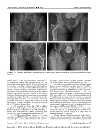 femoral head.8 Valgus intertrochanteric osteotomy11,12
can improve neck-shaft angle and can theoretically im-
prove abductor mechanism, but it does not change rela-
tions between overriding trochanter and the femoral head
nor the relation between the femoral head and the ace-
tabulum. Recently developed relative neck lengthening8,13
may address pathologies of the femoral head and improve
abductor mechanism by distal transfer of the greater
trochanter. Inspection of the acetabulum is an essential
part of this procedure that allows treatment of acetabular
pathology. However, this is a technically demanding
procedure with need of surgical hip dislocation, devel-
opment of an extended retinacular ﬂap with the potential
risk of AVN of the femoral head.
In 1980 Morscher developed the FNLO to address
correction of neck length, LLD, and abductor tension.
Preliminary results were published in 1988, describing 15
patients who underwent the surgery, conﬁrming good
outcome with regard to biomechanics and function.4
In 1990, Morscher published a series of 37 patients
who underwent FNLO, with a mean follow-up period of
8 years (range, 1 to 16 y), and concluded that it improves
leg length, abductor force and gait, provided that there
are no or minimal arthritic changes in the hip joint.14
All patients presented in this study, when evaluated
before surgery, had abnormal gait, positive Trendelen-
burg sign, LLD, pain and fatigue during activity. On
postoperative follow-up, LLD was reduced in all patients,
with mean 1.3 cm of reduction, from mean LLD of 2.1 cm
to mean LLD of 0.8 cm, similar to the results presented by
Morscher in his work.14 Most of the patients had negative
Trendelenburg sign, improved gait pattern and reported
better function, reduced fatigue, and less hip discomfort.
Data were validated by an objective criteria measured by
the HHS (preoperatively and at the latest follow-up) and
demonstrated improvement in all parameters with a me-
dian increase of 17 points (IQR: 8.2 to 27.2).
There were several complications in our series:
hardware failure in 3, wire breakage in 2, and blade mi-
gration requiring revision surgery in 1. There were no
cases of nonunion or infection.
During follow-up, 3 patients presented clinical and ra-
diologic signs of osteoarthritis. One patient demonstrated
rapid deterioration to end-stage osteoarthritis, requiring total
FIGURE 5. A–D, Bilateral femoral neck lengthening in a 13-year-old girl. Seven-year follow-up radiographs demonstrates good
outcome.
J Pediatr Orthop  Volume 00, Number 00, ’’ 2016 Femoral Neck Lengthening
Copyright r 2016 Wolters Kluwer Health, Inc. All rights reserved. www.pedorthopaedics.com | 5
Copyright r 2016 Wolters Kluwer Health, Inc. Unauthorized reproduction of this article is prohibited.
 
