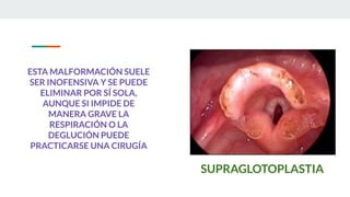 ESTA MALFORMACIÓN SUELE
SER INOFENSIVA Y SE PUEDE
ELIMINAR POR SÍ SOLA,
AUNQUE SI IMPIDE DE
MANERA GRAVE LA
RESPIRACIÓN O LA
DEGLUCIÓN PUEDE
PRACTICARSE UNA CIRUGÍA
SUPRAGLOTOPLASTIA
 