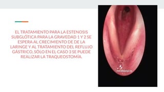 EL TRATAMIENTO PARA LA ESTENOSIS
SUBGLÓTICA PARA LA GRAVEDAD 1 Y 2 SE
ESPERA AL CRECIMIENTO DE DE LA
LARINGE Y AL TRATAMIENTO DEL REFLUJO
GÁSTRICO, SÓLO EN EL CASO 3 SE PUEDE
REALIZAR LA TRAQUEOSTOMÍA.
 