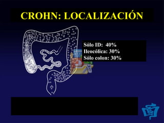 CROHN: LOCALIZACIÓN
Sólo ID: 40%
Ileocólica: 30%
Sólo colon: 30%
 