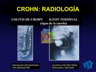 (reproduced with permission
from McGraw-Hill)
(courtesy of Dr Sten Norby
Rasmussen, Denmark)
CROHN: RADIOLOGÍA
COLITIS DE CROHN ILEON TERMINAL
(signo de la cuerda)
 
