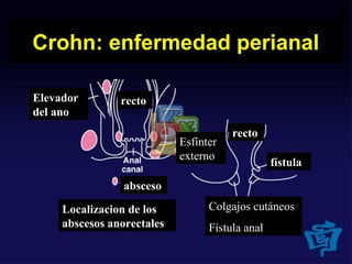 Crohn: enfermedad perianal
Localizacion de los
abscesos anorectales
Colgajos cutáneos
Fístula anal
Esfínter
externo
absceso
rectoElevador
del ano
recto
fístula
 