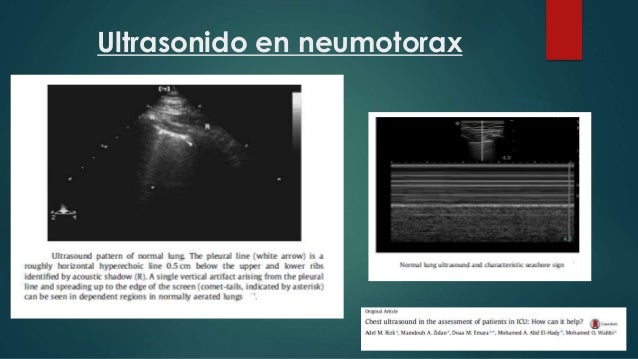 Neumotorax en uci