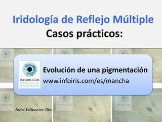 Evolución de una pigmentación
www.infoiris.com/es/mancha
Iridología de Reflejo Múltiple
Casos prácticos:
Javier Echavarren Otín
 