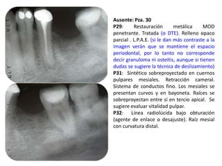 Ausente: Pza. 30P29: Restauración metálica MOD penetrante. Tratada (o DTE). Relleno opaco parcial . L.P.A.E. (si le dan más contraste a la imagen verán que se mantiene el espacio periodontal, por lo tanto no corresponde decir granuloma ni osteítis, aunque si tienen dudas se sugiere la técnica de deslizamiento)P31:  Sintético sobreproyectado en cuernos pulpares mesiales. Retracción cameral. Sistema de conductos fino. Los mesiales se presentan curvos y en bayoneta. Raíces se sobreproyectan entre sí en tercio apical.  Se sugiere evaluar vitalidad pulpar.P32:  Línea radiolúcida bajo obturación (agente de enlace o desajuste). Raíz mesial con curvatura distal.. 