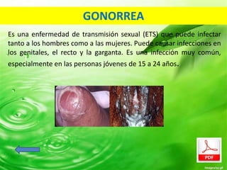 GONORREA 
Es una enfermedad de transmisión sexual (ETS) que puede infectar 
tanto a los hombres como a las mujeres. Puede causar infecciones en 
los genitales, el recto y la garganta. Es una infección muy común, 
especialmente en las personas jóvenes de 15 a 24 años. 
 