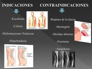 INDICACIONES CONTRAINDICACIONES
-Escoliosis
-Cifosis
-Deformaciones Torácicas
-Hiperlordosis
-Ruptura de la fascia
-Meningitis
-Heridas abiertas
-Fracturas
-Anquilosis
 