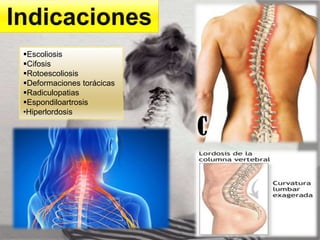 Escoliosis
Cifosis
Rotoescoliosis
Deformaciones torácicas
Radiculopatias
Espondiloartrosis
•Hiperlordosis
 