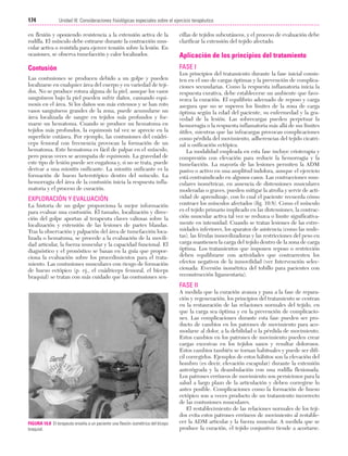 Cap. 10

23/3/06

20:36

Página 174

174

Unidad III: Consideraciones fisiológicas especiales sobre el ejercicio terapéutico
...................................................................................................................................................

en flexión y oponiendo resistencia a la extensión activa de la
rodilla. El músculo debe estirarse durante la contracción muscular activa o resistida para ejercer tensión sobre la lesión. En
ocasiones, se observa tumefacción y calor localizados.

cillas de tejidos subcutáneos, y el proceso de evaluación debe
clarificar la extensión del tejido afectado.

Contusión

FASE I

Las contusiones se producen debido a un golpe y pueden
localizarse en cualquier área del cuerpo y en variedad de tejidos. No se produce rotura alguna de la piel, aunque los vasos
sanguíneos bajo la piel pueden sufrir daños, causando equimosis en el área. Si los daños son más extensos y se han roto
vasos sanguíneos grandes de la zona, puede acumularse un
área localizada de sangre en tejidos más profundos y formarse un hematoma. Cuando se produce un hematoma en
tejidos más profundos, la equimosis tal vez se aprecie en la
superficie cutánea. Por ejemplo, las contusiones del cuádriceps femoral con frecuencia provocan la formación de un
hematoma. Este hematoma es fácil de palpar en el músculo,
pero pocas veces se acompaña de equimosis. La gravedad de
este tipo de lesión puede ser engañosa y, si no se trata, puede
derivar a una miositis osificante. La miositis osificante es la
formación de hueso heterotópico dentro del músculo. La
hemorragia del área de la contusión inicia la respuesta inflamatoria y el proceso de curación.

EXPLORACIÓN Y EVALUACIÓN
La historia de un golpe proporciona la mejor información
para evaluar una contusión. El tamaño, localización y dirección del golpe aportan al terapeuta claves valiosas sobre la
localización y extensión de las lesiones de partes blandas.
Tras la observación y palpación del área de tumefacción localizada o hematoma, se procede a la evaluación de la movilidad articular, la fuerza muscular y la capacidad funcional. El
diagnóstico y el pronóstico se basan en la guía que proporciona la evaluación sobre los procedimientos para el tratamiento. Las contusiones musculares con riesgo de formación
de hueso ectópico (p. ej., el cuádriceps femoral, el bíceps
braquial) se tratan con más cuidado que las contusiones sen-

Aplicación de los principios del tratamiento
Los principios del tratamiento durante la fase inicial consisten en el uso de cargas óptimas y la prevención de complicaciones secundarias. Como la respuesta inflamatoria inicia la
respuesta curativa, debe establecerse un ambiente que favorezca la curación. El equilibrio adecuado de reposo y carga
asegura que no se superen los límites de la zona de carga
óptima según la edad del paciente, su enfermedad y la gravedad de la lesión. Las sobrecargas pueden perpetuar la
hemorragia o la respuesta inflamatoria más allá de sus límites
útiles, mientras que las infracargas provocan complicaciones
como pérdida del movimiento, adherencias del tejido cicatrizal u osificación ectópica.
La modalidad empleada en esta fase incluye crioterapia y
compresión con elevación para reducir la hemorragia y la
tumefacción. La mayoría de las lesiones permiten la ADM
pasivo o activo en una amplitud indolora, aunque el ejercicio
está contraindicado en algunos casos. Las contracciones musculares isométricas, en ausencia de distensiones musculares
moderadas o graves, pueden mitigar la atrofia y servir de actividad de aprendizaje, con lo cual el paciente recuerda cómo
contraer los músculos afectados (fig. 10.8). Como el músculo
es el tejido primario implicado en las distensiones, la contracción muscular activa tal vez se reduzca o limite significativamente en intensidad. Cuando se tratan lesiones de las extremidades inferiores, los aparatos de asistencia (como las muletas), las férulas inmovilizadoras y las restricciones del peso en
carga mantienen la carga del tejido dentro de la zona de carga
óptima. Los tratamientos que imponen reposo o restricción
deben equilibrarse con actividades que contrarresten los
efectos negativos de la inmovilidad (ver Intervención seleccionada: Eversión isométrica del tobillo para pacientes con
reconstrucción ligamentaria).

FASE II

FIGURA 10.8 El terapeuta enseña a un paciente una flexión isométrica del bíceps
braquial.

A medida que la curación avanza y pasa a la fase de reparación y regeneración, los principios del tratamiento se centran
en la restauración de las relaciones normales del tejido, en
que la carga sea óptima y en la prevención de complicaciones. Las complicaciones durante esta fase pueden ser producto de cambios en los patrones de movimiento para acomodarse al dolor, a la debilidad o la pérdida de movimiento.
Estos cambios en los patrones de movimiento pueden crear
cargas excesivas en los tejidos sanos y resultar dolorosos.
Estos cambios también se tornan habituales y puede ser difícil corregirlos. Ejemplos de estos hábitos son la elevación del
hombro (es decir, elevación escapular) durante la extensión
anterógrada y la deambulación con una rodilla flexionada.
Los patrones erróneos de movimiento son perniciosos para la
salud a largo plazo de la articulación y deben corregirse lo
antes posible. Complicaciones como la formación de hueso
ectópico son a veces producto de un tratamiento incorrecto
de las contusiones musculares.
El restablecimiento de las relaciones normales de los tejidos evita estos patrones erróneos de movimiento al restablecer la ADM articular y la fuerza muscular. A medida que se
produce la curación, el tejido conjuntivo tiende a acortarse.

 