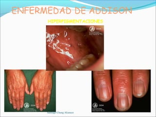 HIPERPIGMENTACIONES




Santiago Chung Alcarazo
 