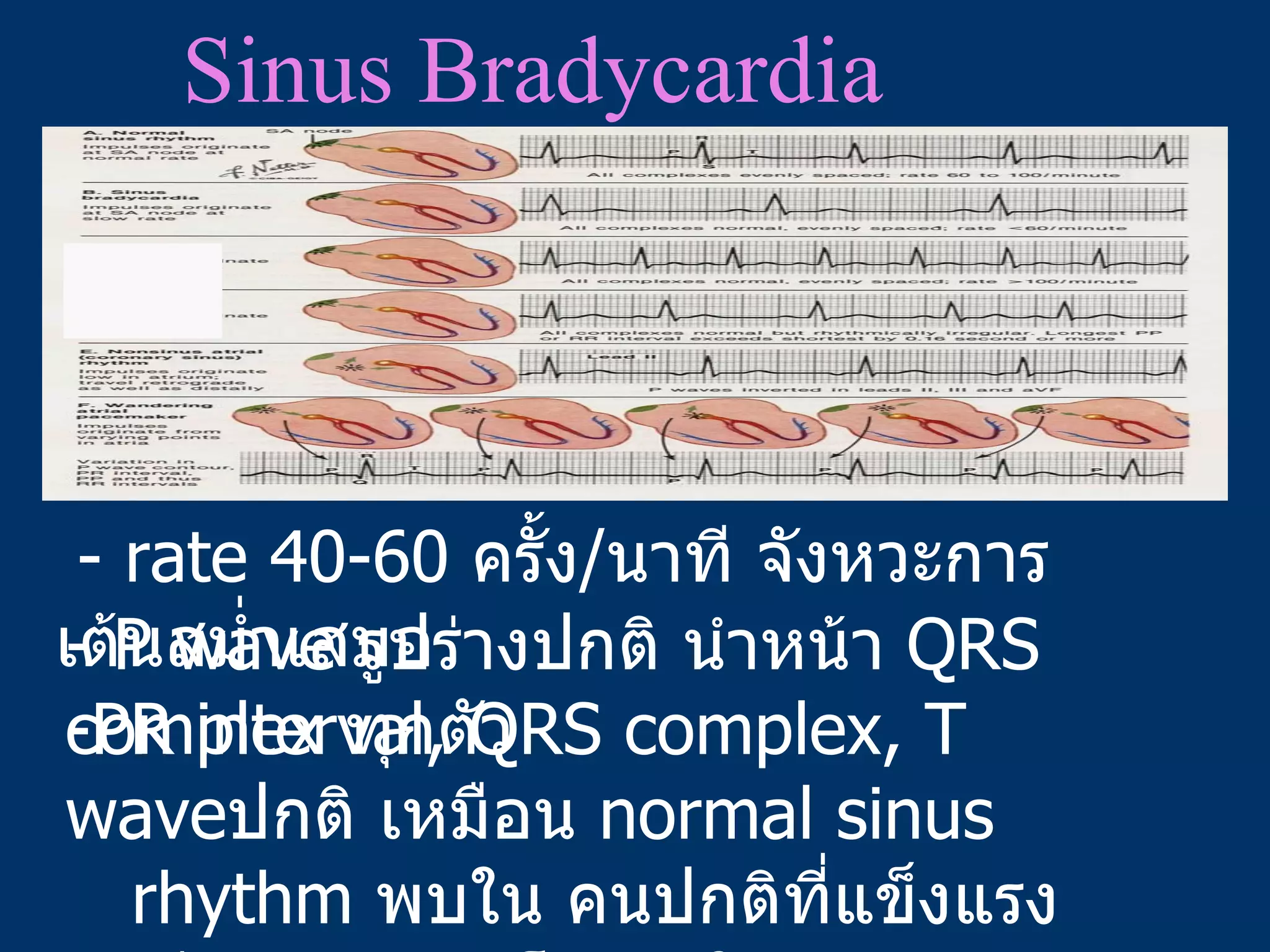 Sinus Bradycardia - rate 40-60  ครั้ง / นาที จังหวะการเต้นสม่ำเสมอ - P wave  รูปร่างปกติ นำหน้า  QRS complex  ทุกตัว PR interval, QRS complex, T wave ปกติ เหมือน  normal sinus    rhythm  พบใน คนปกติที่แข็งแรง นักกีฬา สูงอายุ โรคหัวใจ    หรือได้รับยา  B-blocker, amiodarone, digitalis  
