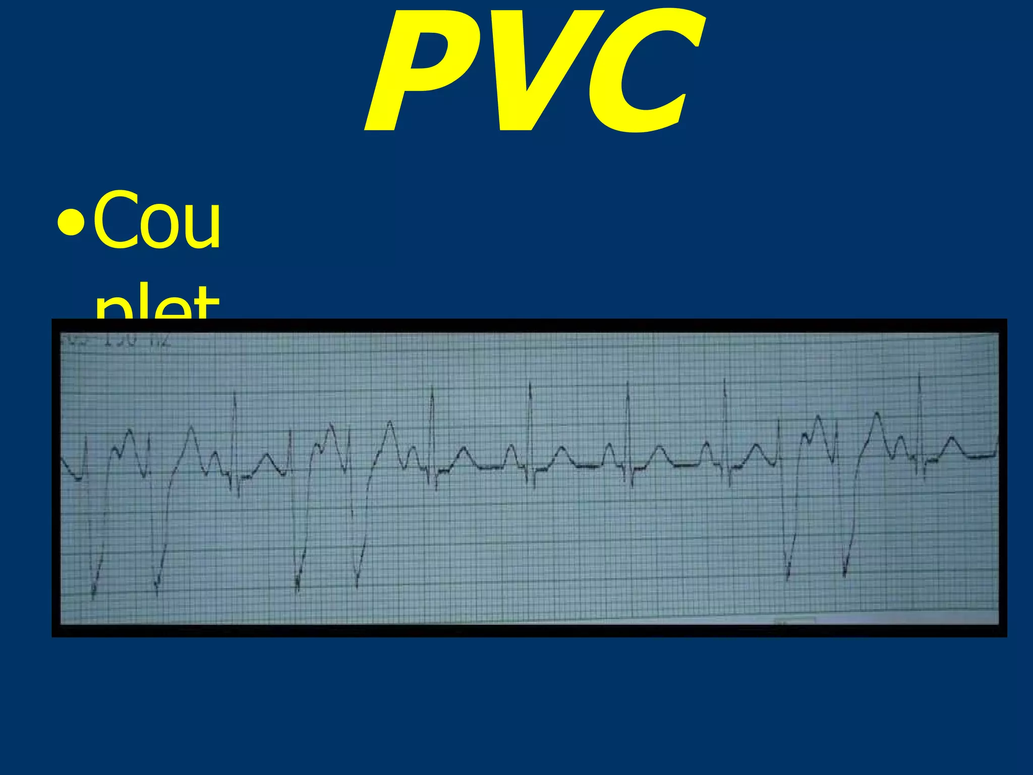 PVC Couplet 