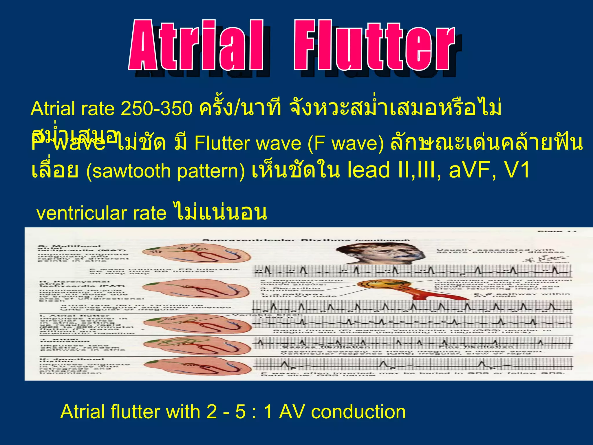 Atrial rate 250-350  ครั้ง / นาที   จังหวะ สม่ำเสมอหรือไม่สม่ำเสมอ   P wave   ไม่ชัด มี   Flutter wave (F wave)   ลักษณะ เด่น คล้าย ฟันเลื่อย   (sawtooth pattern)   เห็นชัดใน   lead II,III, aVF, V1 ventricular rate  ไม่แน่นอน  Atrial  Flutter Atrial flutter with 2 - 5 : 1 AV conduction 