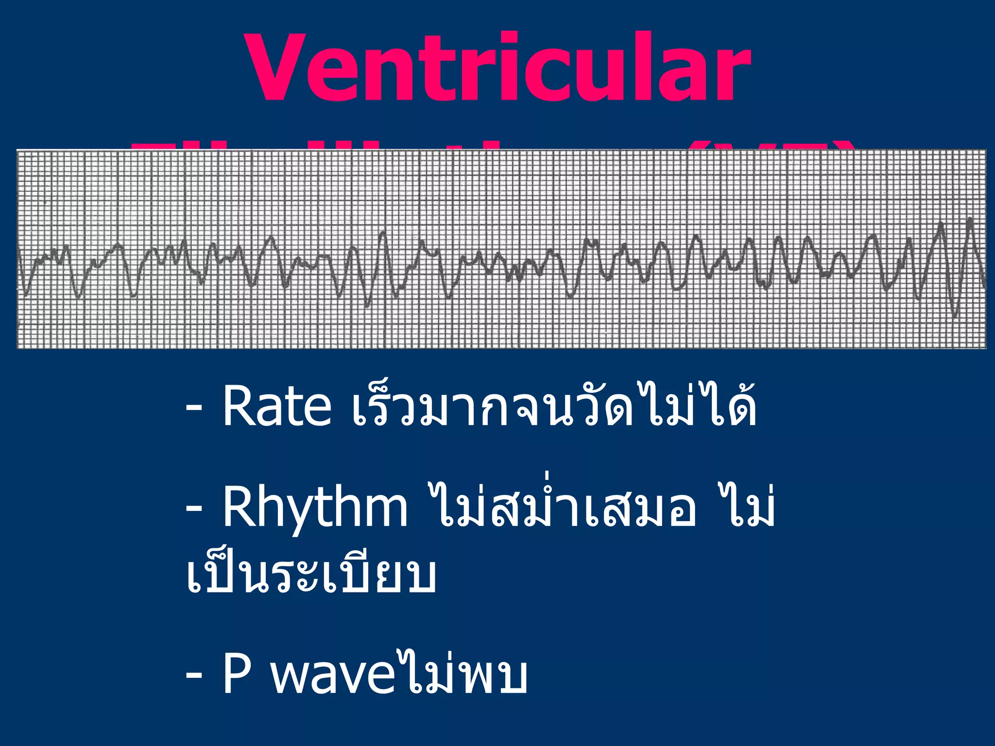 Ventricular Fibrillation  (VF) - Rate  เร็วมากจนวัดไม่ได้ - Rhythm  ไม่สม่ำเสมอ ไม่เป็นระเบียบ - P wave ไม่พบ - QRS complexes or T wave  แยกไม่ได้ 