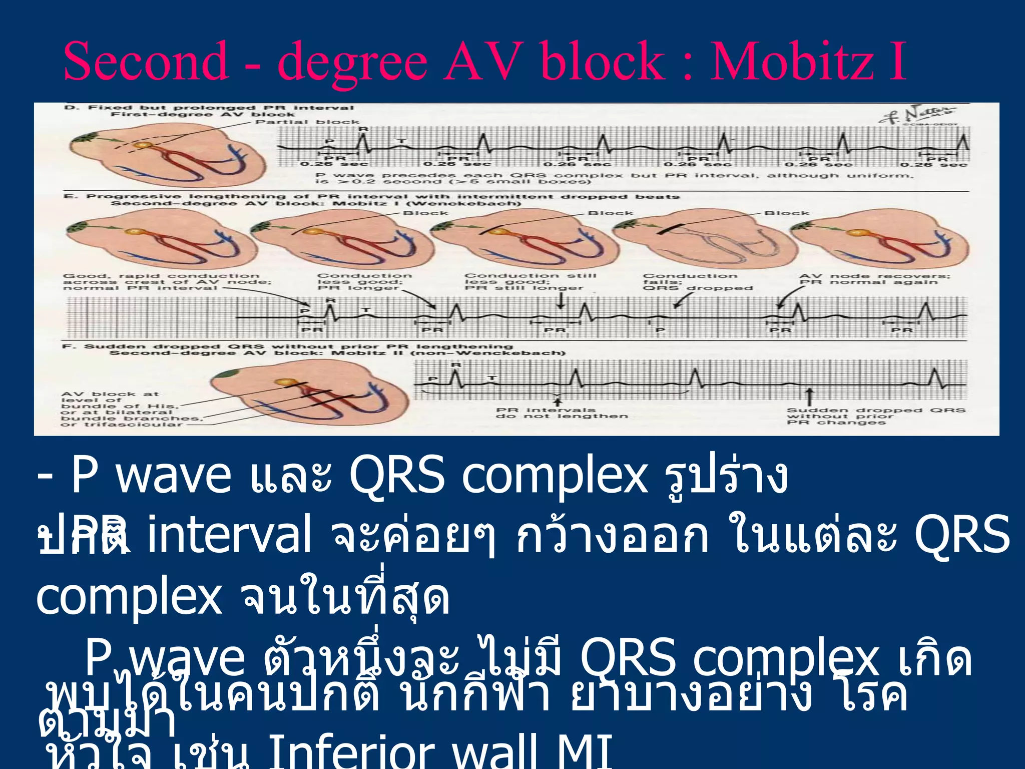 Second - degree AV block : Mobitz I - P wave  และ   QRS complex  รูปร่างปกติ - PR interval  จะค่อยๆ  กว้าง ออก ในแต่ละ  QRS complex  จนในที่สุด    P wave  ตัว หนึ่งจะ ไม่มี   QRS complex   เกิดตามมา พบได้ในคนปกติ นักกีฬา ยาบางอย่าง โรคหัวใจ เช่น  Inferior wall MI 