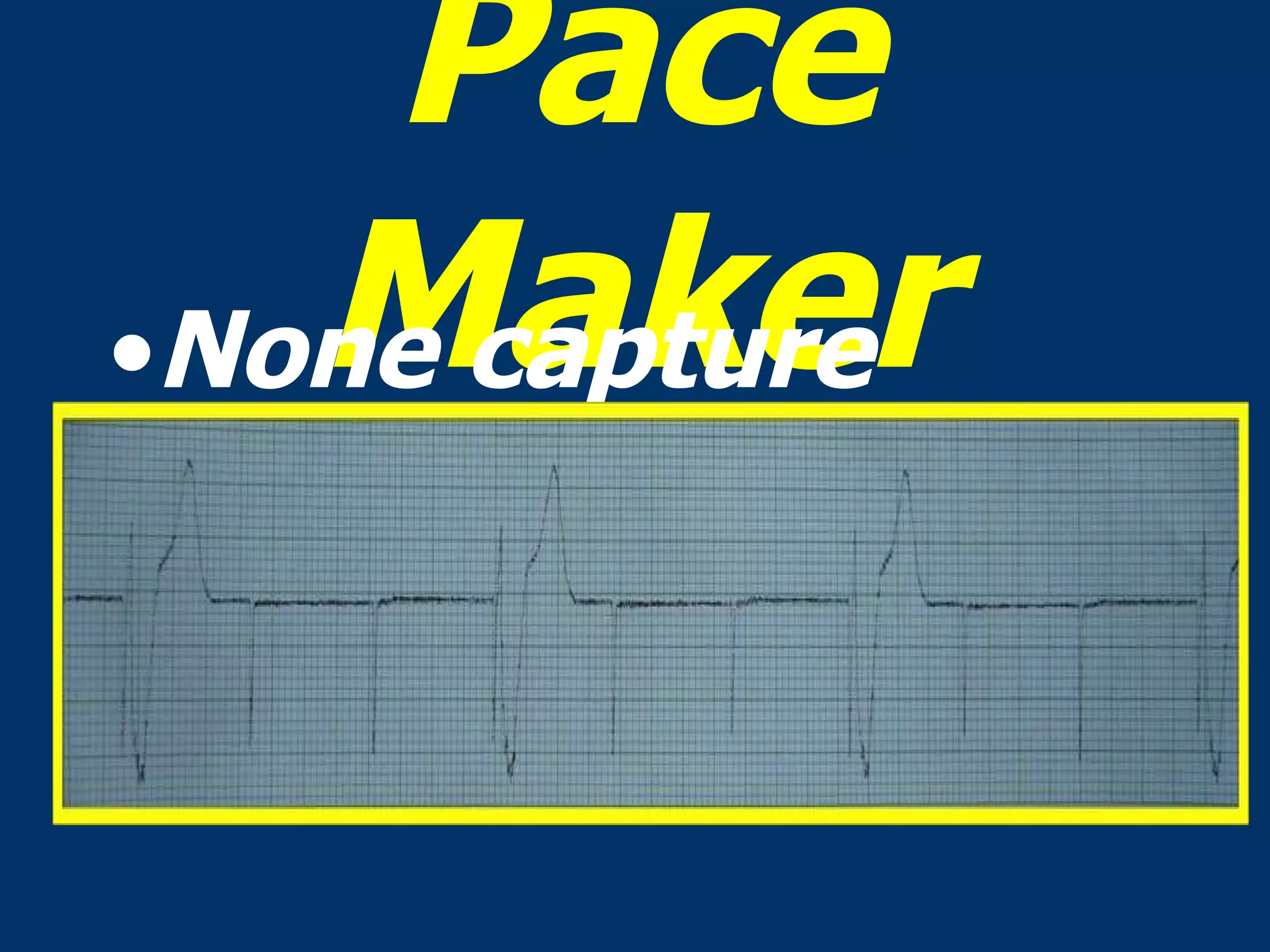 Pace Maker None capture 