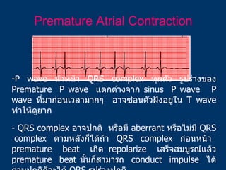 <ul><li>P wave  นำหน้า  QRS complex  ทุกตัว รูปร่างของ  Premature  P wave  แตกต่างจาก  sinus  P wave  P wave  ที่มาก่อนเวล...