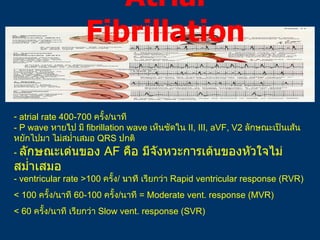 Atrial Fibrillation <ul><li>atrial rate 400-700  ครั้ง / นาที - P wave  หาย ไ ป มี  fibrillation wave  เห็นชัดใน  II, III,...
