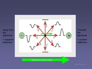 medics.cc
medics.cc
medics.cc
medics.cc
medics.cc
medics.cc
Direction of impulse (axis)
Towards
the
electrode
= positive
deflection
Away from
the
electrode
= negative
deflection
 