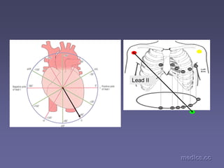 medics.cc
medics.cc
medics.cc
medics.cc
medics.cc
medics.cc
Lead II
 