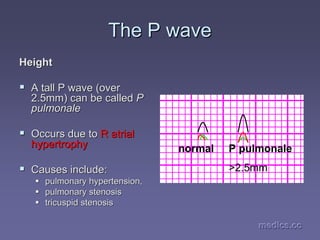medics.cc
medics.cc
medics.cc
medics.cc
medics.cc
medics.cc
The P wave
The P wave
Height
Height
ƒ
ƒ A tall P wave (over
A tall P wave (over
2.5mm) can be called
2.5mm) can be called P
P
pulmonale
pulmonale
ƒ
ƒ Occurs due to
Occurs due to R
R atrial
atrial
hypertrophy
hypertrophy
ƒ
ƒ Causes include:
Causes include:
ƒ
ƒ pulmonary hypertension,
pulmonary hypertension,
ƒ
ƒ pulmonary
pulmonary stenosis
stenosis
ƒ
ƒ tricuspid
tricuspid stenosis
stenosis
normal P pulmonale
>2.5mm
 