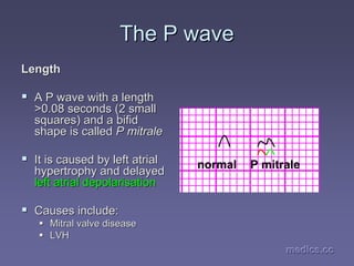 medics.cc
medics.cc
medics.cc
medics.cc
medics.cc
medics.cc
The P wave
The P wave
Length
Length
ƒ
ƒ A P wave with a length
A P wave with a length
>0.08 seconds (2 small
>0.08 seconds (2 small
squares) and a bifid
squares) and a bifid
shape is called
shape is called P
P mitrale
mitrale
ƒ
ƒ It is caused by left
It is caused by left atrial
atrial
hypertrophy and delayed
hypertrophy and delayed
left
left atrial
atrial depolarisation
depolarisation
ƒ
ƒ Causes include:
Causes include:
ƒ
ƒ Mitral valve disease
Mitral valve disease
ƒ
ƒ LVH
LVH
normal P mitrale
 
