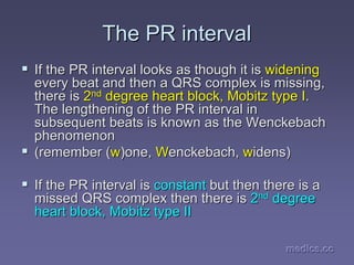 medics.cc
medics.cc
medics.cc
medics.cc
medics.cc
medics.cc
The PR interval
The PR interval
ƒ
ƒ If the PR interval looks as though it is
If the PR interval looks as though it is widening
widening
every beat and then a QRS complex is missing,
every beat and then a QRS complex is missing,
there is
there is 2
2nd
nd degree heart block,
degree heart block, Mobitz
Mobitz type I
type I.
.
The lengthening of the PR interval in
The lengthening of the PR interval in
subsequent beats is known as the
subsequent beats is known as the Wenckebach
Wenckebach
phenomenon
phenomenon
ƒ
ƒ (remember (
(remember (w
w)one,
)one, W
Wenckebach
enckebach,
, w
widens)
idens)
ƒ
ƒ If the PR interval is
If the PR interval is constant
constant but then there is a
but then there is a
missed QRS complex then there is
missed QRS complex then there is 2
2nd
nd degree
degree
heart block,
heart block, Mobitz
Mobitz type II
type II
 