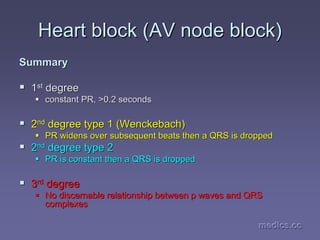 medics.cc
medics.cc
medics.cc
medics.cc
medics.cc
medics.cc
Heart block (AV node block)
Heart block (AV node block)
Summary
Summary
ƒ
ƒ 1
1st
st degree
degree
ƒ
ƒ constant PR, >0.2 seconds
constant PR, >0.2 seconds
ƒ
ƒ 2
2nd
nd degree type 1 (
degree type 1 (Wenckebach
Wenckebach)
)
ƒ
ƒ PR widens over subsequent beats then a QRS is dropped
PR widens over subsequent beats then a QRS is dropped
ƒ
ƒ 2
2nd
nd degree type 2
degree type 2
ƒ
ƒ PR is constant then a QRS is dropped
PR is constant then a QRS is dropped
ƒ
ƒ 3
3rd
rd degree
degree
ƒ
ƒ No discernable relationship between p waves and QRS
No discernable relationship between p waves and QRS
complexes
complexes
 