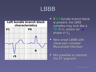 medics.cc
medics.cc
medics.cc
medics.cc
medics.cc
medics.cc
LBBB
LBBB
ƒ
ƒ If
If left
left bundle branch block
bundle branch block
is present, the QRS
is present, the QRS
complex may look like a
complex may look like a
‘
‘W
W’
’ in V
in V1
1 and/or an
and/or an ‘
‘M
M’
’
shape in V
shape in V6.
6.
ƒ
ƒ New onset LBBB with
New onset LBBB with
chest pain consider
chest pain consider
Myocardial infarction
Myocardial infarction
ƒ
ƒ Not possible to interpret
Not possible to interpret
the ST segment.
the ST segment.
 
