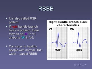 medics.cc
medics.cc
medics.cc
medics.cc
medics.cc
medics.cc
RBBB
RBBB
ƒ
ƒ It is also called RSR
It is also called RSR
pattern
pattern
ƒ
ƒ If
If right
right bundle branch
bundle branch
block is present, there
block is present, there
may be an
may be an ‘
‘M
M’
’ in V1
in V1
and/or a
and/or a ‘
‘W
W’
’ in V6.
in V6.
ƒ
ƒ Can occur in healthy
Can occur in healthy
people with normal QRS
people with normal QRS
width
width –
– partial RBBB
partial RBBB
 