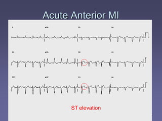 medics.cc
medics.cc
medics.cc
medics.cc
medics.cc
medics.cc
Acute Anterior MI
Acute Anterior MI
ST elevation
 