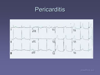 medics.cc
medics.cc
medics.cc
medics.cc
medics.cc
medics.cc
Pericarditis
Pericarditis
 