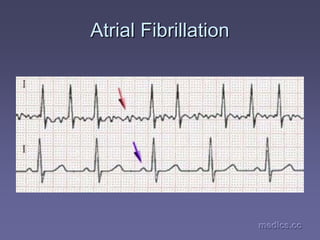 medics.cc
medics.cc
medics.cc
medics.cc
medics.cc
medics.cc
Atrial
Atrial Fibrillation
Fibrillation
 