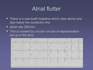 medics.cc
medics.cc
medics.cc
medics.cc
medics.cc
medics.cc
Atrial
Atrial flutter
flutter
ƒ
ƒ There is a saw
There is a saw-
-tooth baseline which rises above and
tooth baseline which rises above and
dips below the
dips below the isoelectric
isoelectric line.
line.
ƒ
ƒ Atrial
Atrial rate 250/min
rate 250/min
ƒ
ƒ This is created by circular circuits of depolarisation
This is created by circular circuits of depolarisation
set up in the atria
set up in the atria
 