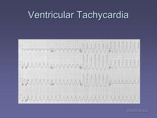 medics.cc
medics.cc
medics.cc
medics.cc
medics.cc
medics.cc
Ventricular Tachycardia
Ventricular Tachycardia
 