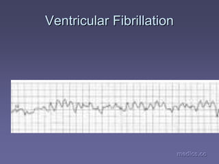 medics.cc
medics.cc
medics.cc
medics.cc
medics.cc
medics.cc
Ventricular Fibrillation
Ventricular Fibrillation
 
