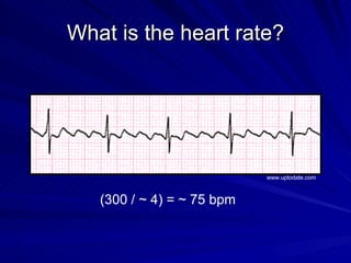 What is the heart rate? (300 / ~ 4) = ~ 75 bpm www.uptodate.com 